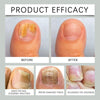 NailDrops 1+1 GRATUIT: Liquid Nail Fungus Réparation Cicatrisation Gouttes