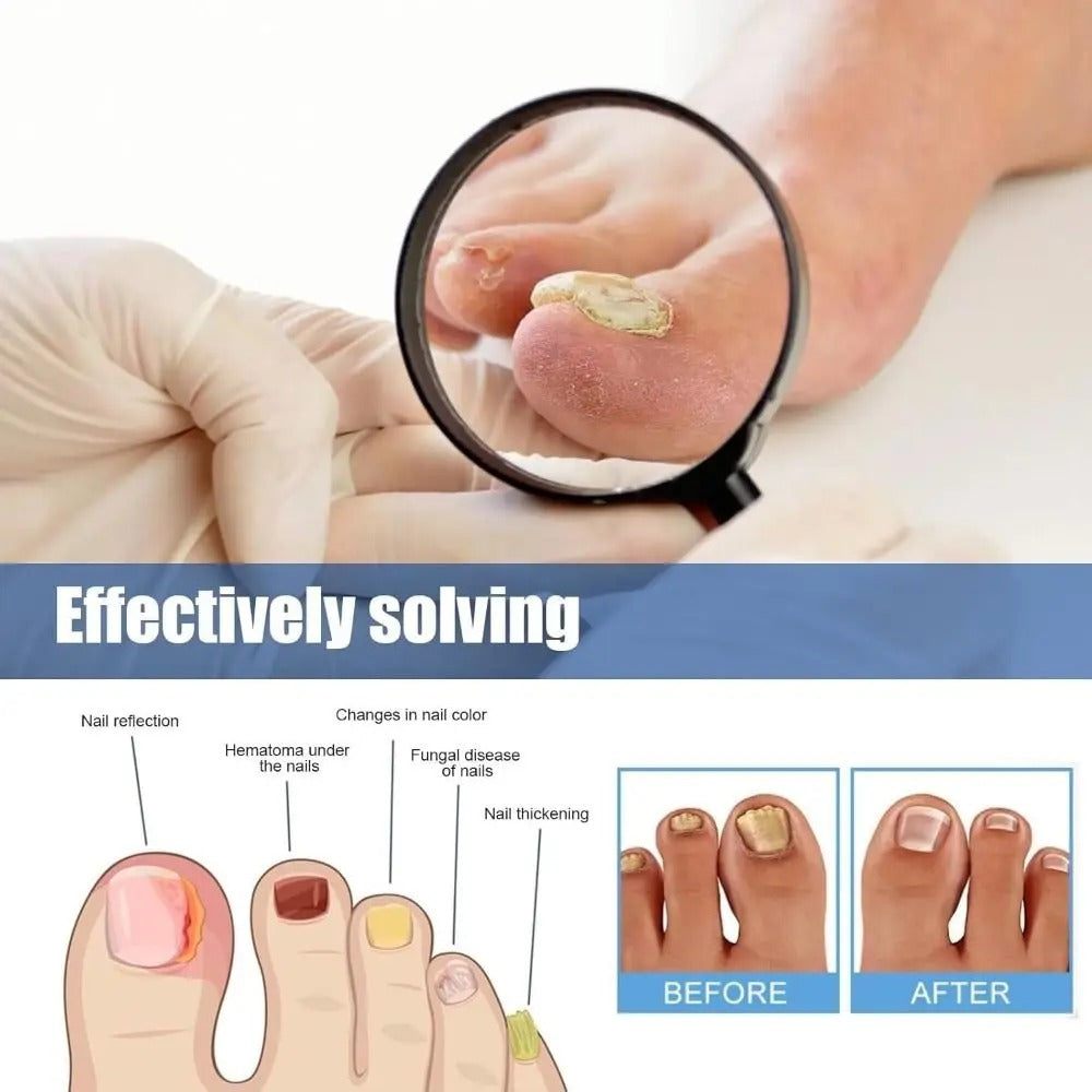 FungalPatch - Patch Antibactérien Et Antifongique Et Pack Soin Des Ongles