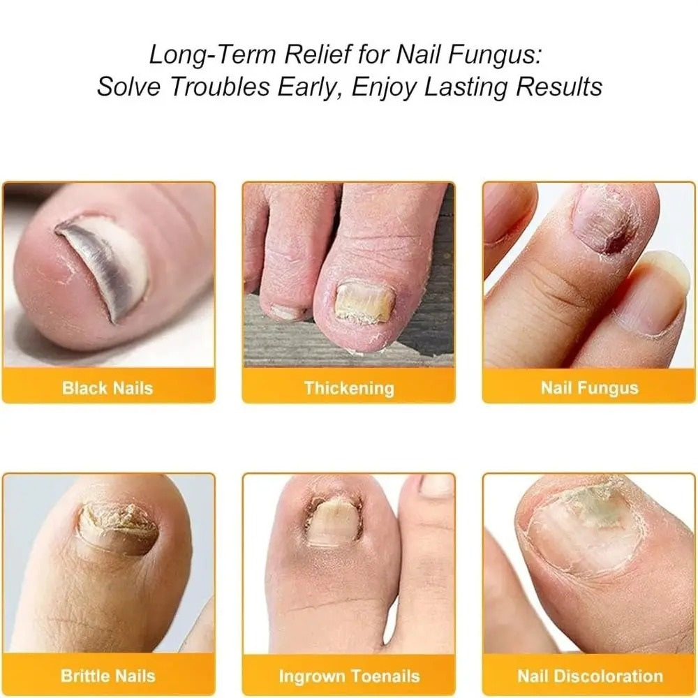 FungalPatch - Patch Antibactérien Et Antifongique Et Pack Soin Des Ongles
