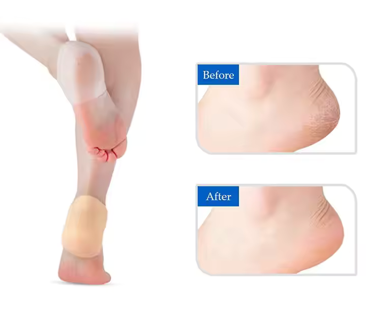 Happy™ HeelProtector 1+1 GRATUIT - Protège-Talon Souple en Silicone